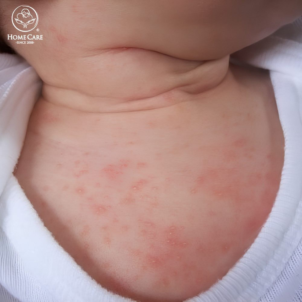 Nguyên nhân nào khiến trẻ bị rôm sảy?
